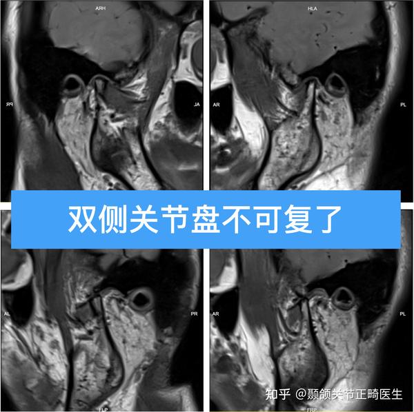 颞下颌关节紊乱为什么要拍核磁共振