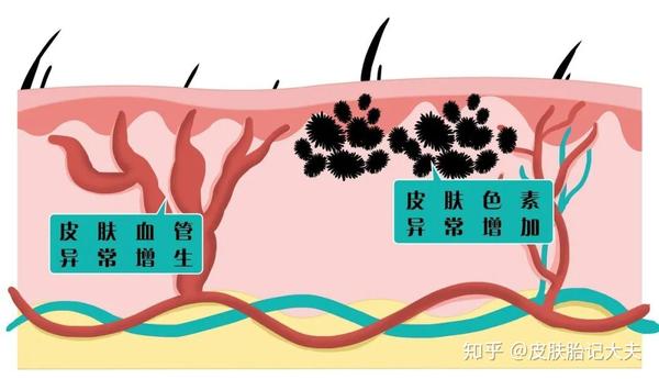 目前的胎记种类主要分为九种:有蒙古斑,咖啡斑,太田痣,色素痣,毛痣