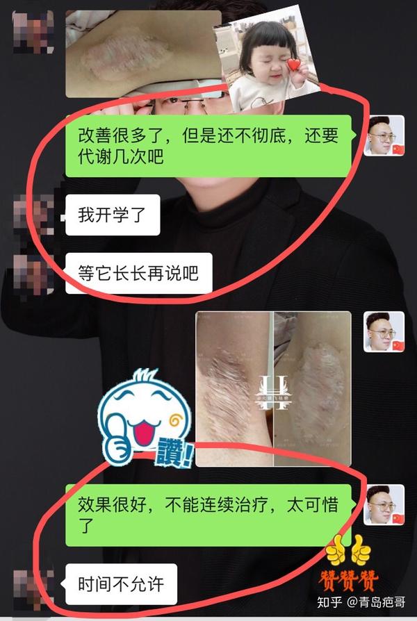 做了狐臭手术后悔了,疤痕真难看