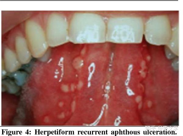 口腔溃疡oralulceration