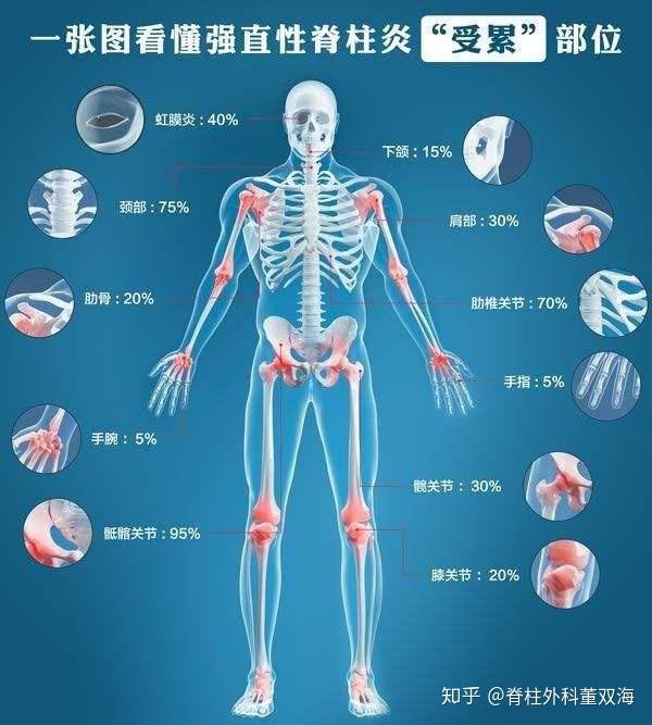 强直性脊柱炎严重危害人类健康,这些危害提前知道早预防