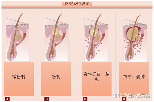 在病理上,脸上痘痘的发生,发展可分为四种状态(如下图).