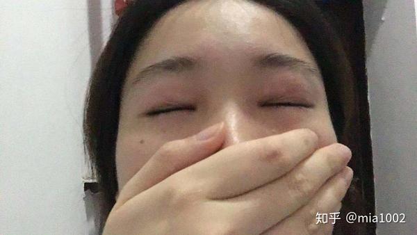 这是四十三分左右拍的照片,已经开始发热眼肿,右眼较严重