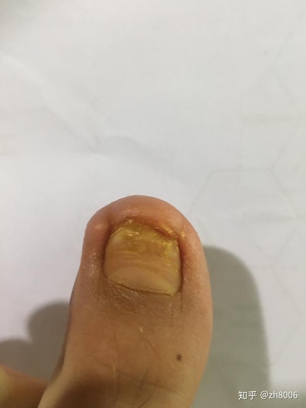 甲沟炎手术痛不痛