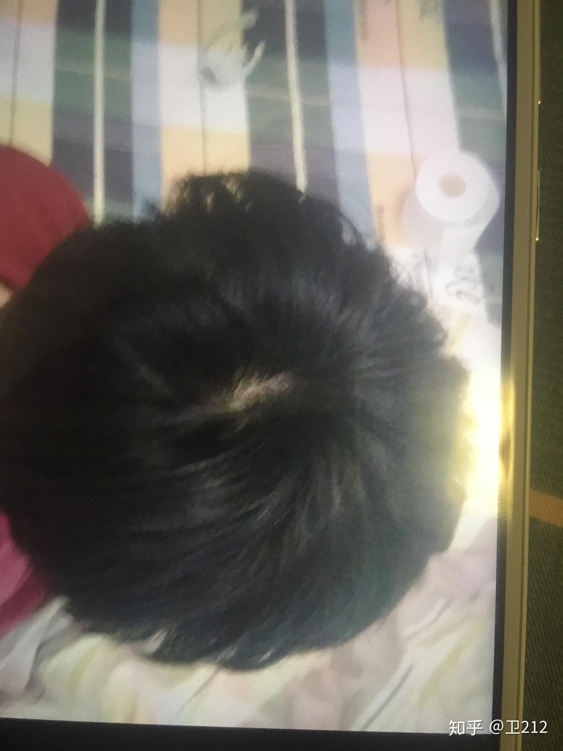 我头顶漩涡处头发是不是很少