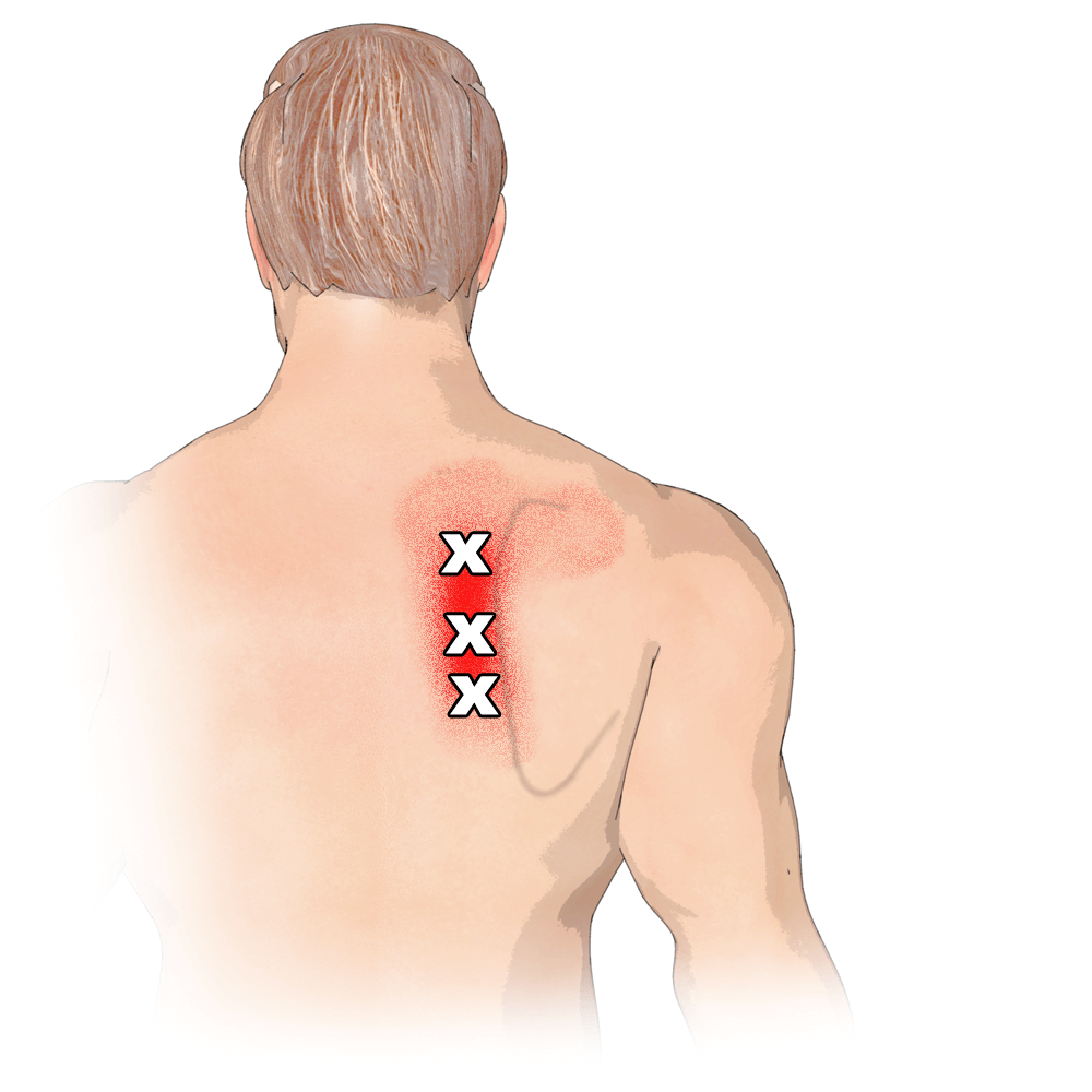 肩胛骨内侧反复疼痛?怎么回事?