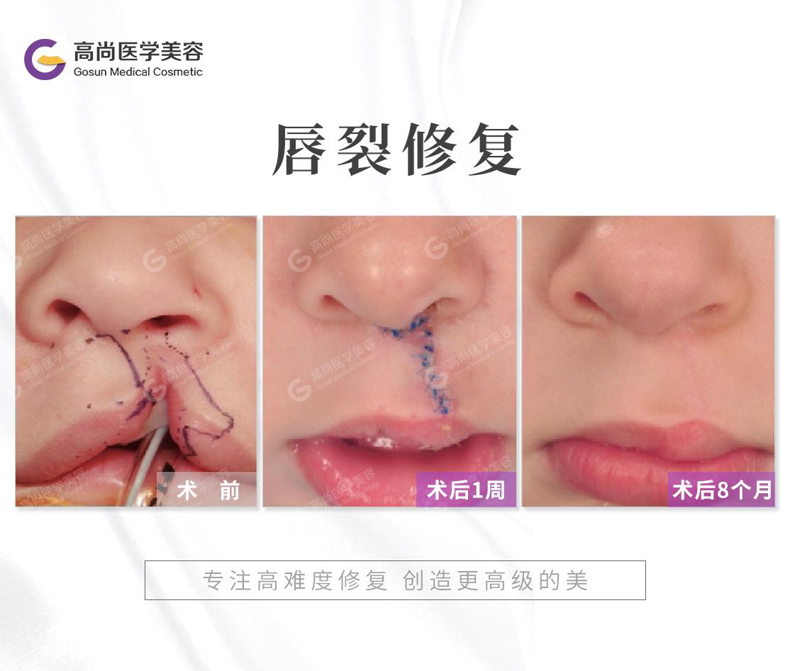 唇裂是什么原因造成的