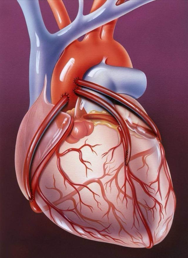 心脏血管堵了一根还有两根能正常运转吗?听听心脏介入