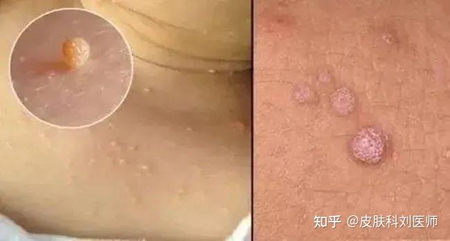 疣是由人类乳头瘤病毒引起的一种皮肤表面赘生物,若是发现自己的皮肤