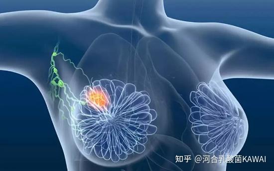 万一得了乳腺癌还有救吗