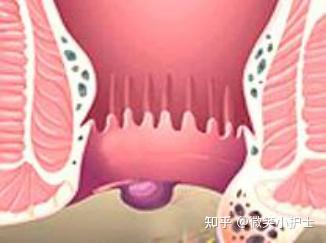 外痔怎么治疗 - 知乎