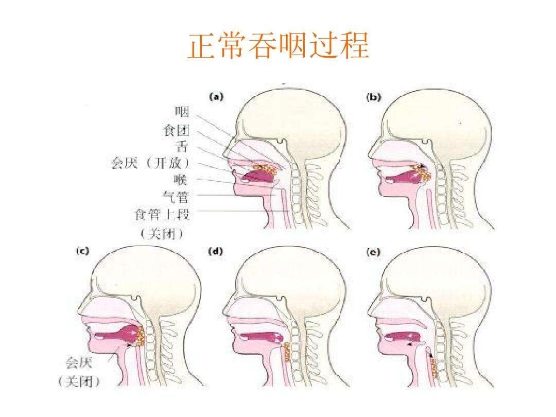 吞咽障碍康复性训练