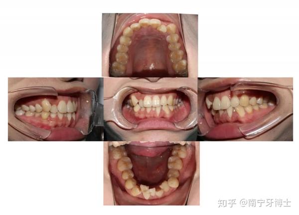 牙齿不齐拥挤案例分享——可以收获健康口腔!