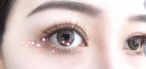 韩式三点双眼皮是永久性的吗?可以做全切双眼皮修复吗