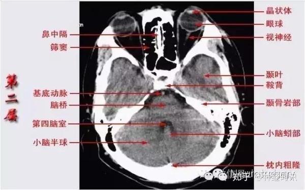 解剖影像颅脑ct解剖口诀及彩色解剖图