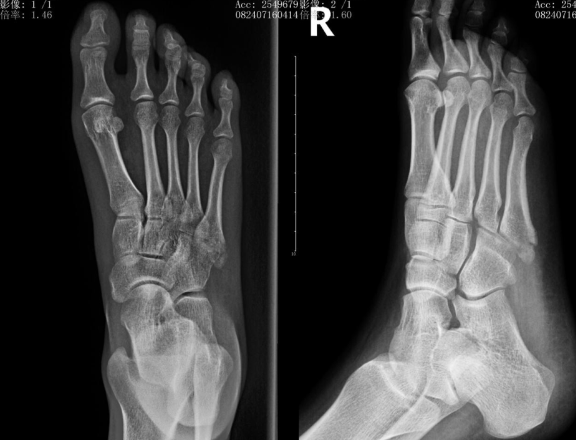 第五跖骨基底部骨折记录2020