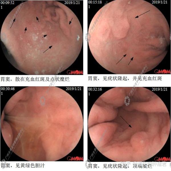 胃癌多是拖出来的