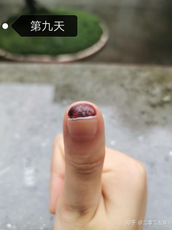 上午做完冷冻,下午回学校.