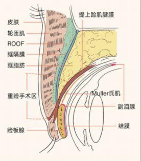 双眼皮手术到底做多宽合适