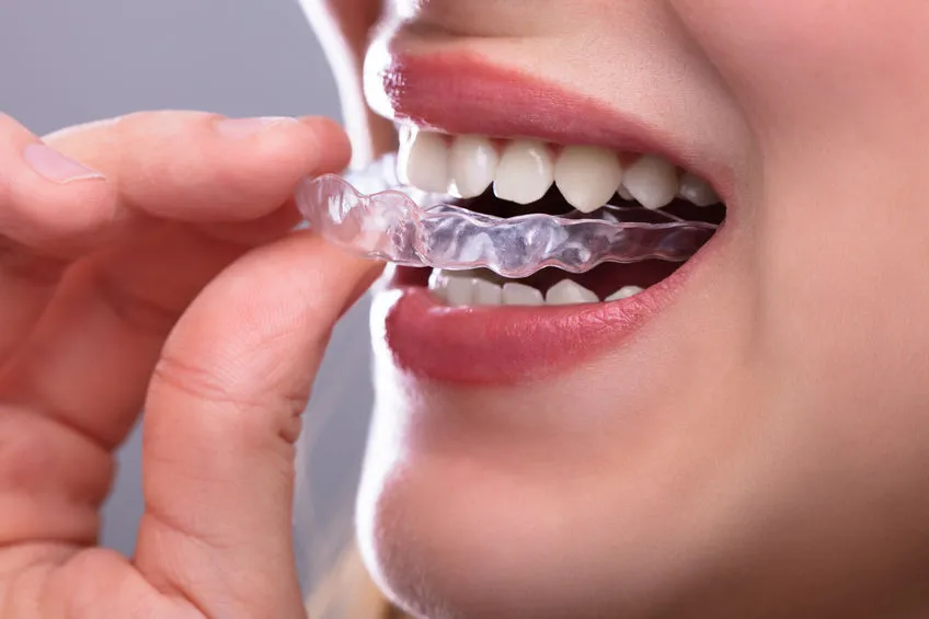 隐形牙套只是普通的"塑料"?