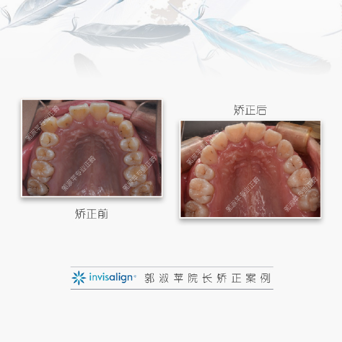 在矫正治疗过程中进行了非常严格的控根移动,实现"轻力持久"的正畸