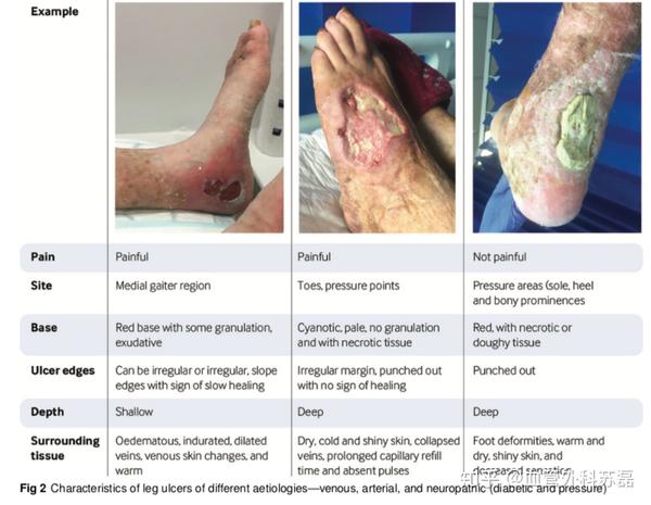 下肢静脉溃疡的诊断与治疗