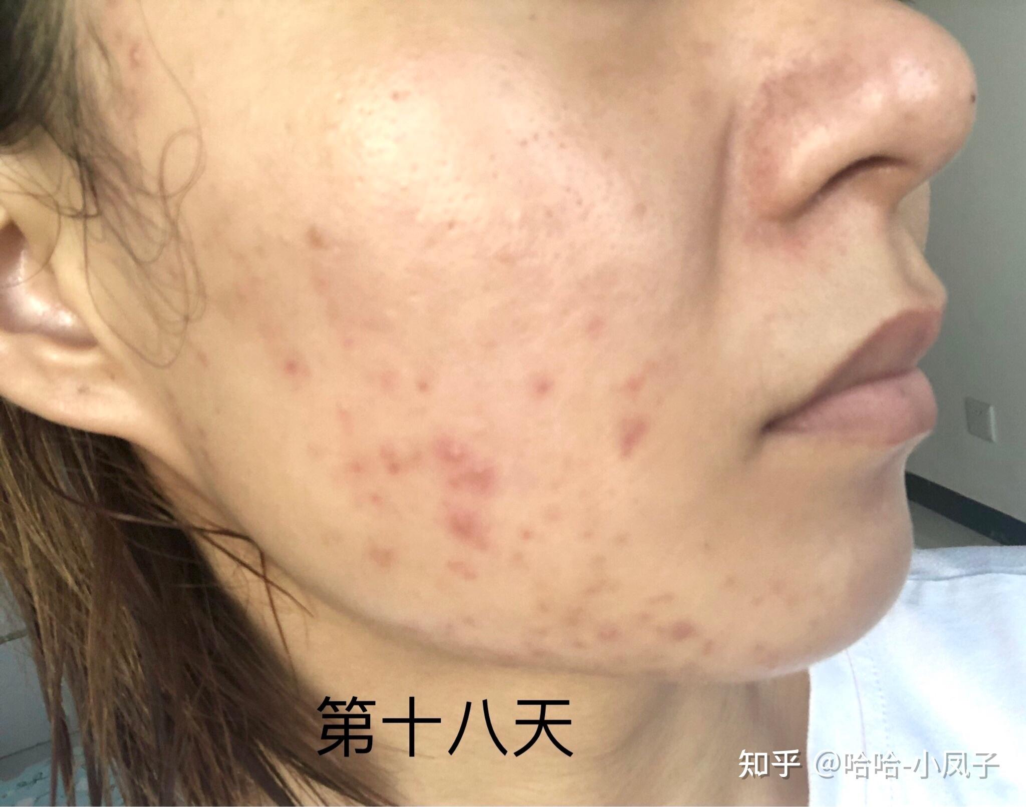 痘痘肌战痘记录