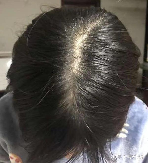 脂溢性脱发好了,终于恢复正常了