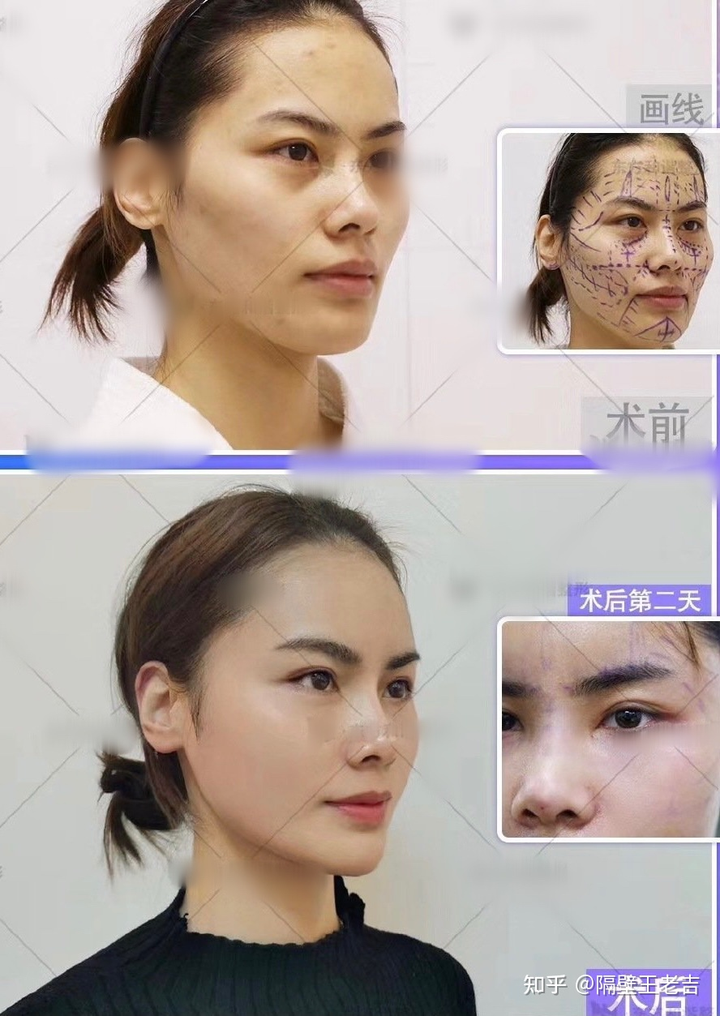 北京脂肪填充专攻医院医生现状情况全脸填充大概要花多少钱
