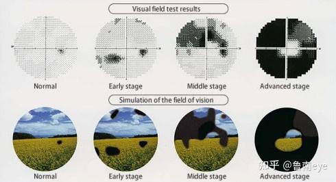 青光眼视野变化