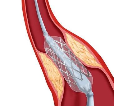 心脏支架术后还犯心绞痛?可能原因有7种!