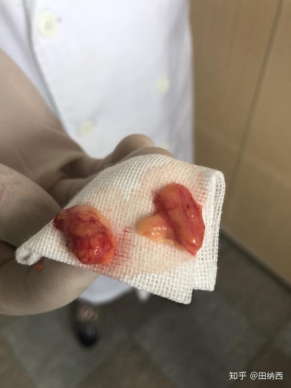 对于肉眼泡来说,做眼部抽脂安全么?