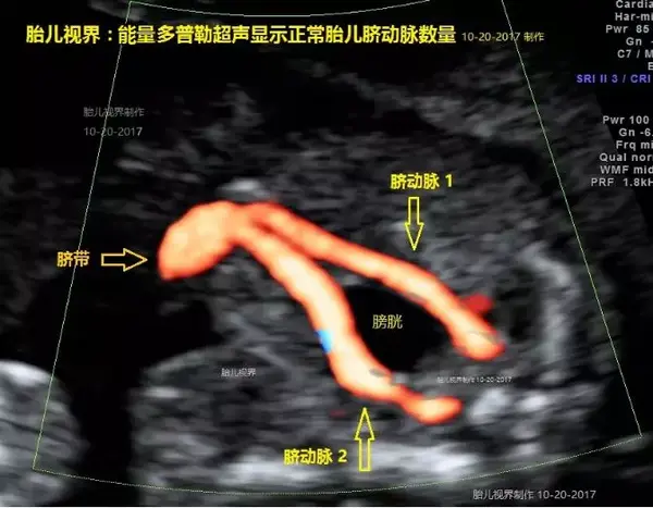 胎儿心脏及血液循环解剖特点
