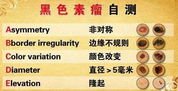 干货分享!什么样的痣需要去除?