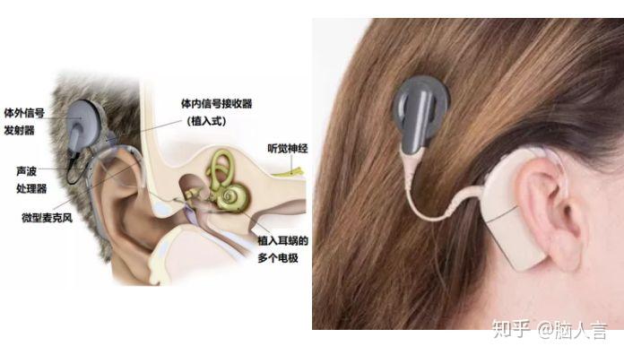人工耳蜗体外和体内植入式系统的示意图,以及在用户使用时的情况 [17