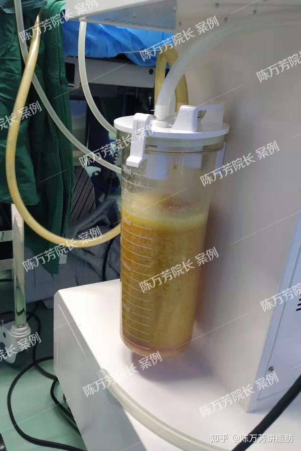 手动静置提取的方式,再无任何添加剂的情况下,分层次注射到胸部; 丰胸