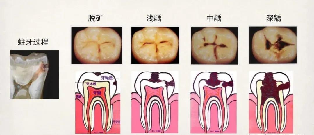 如果你的蛀牙到这种程度了就不能靠补牙拯救了