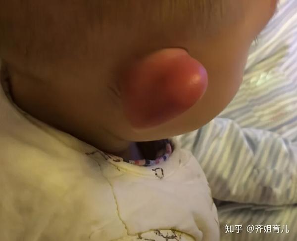 3岁娃被蚊子咬第二天耳朵肿成果冻易过敏体质是咋回事