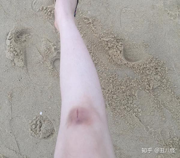 楼梯上摔下来的膝盖