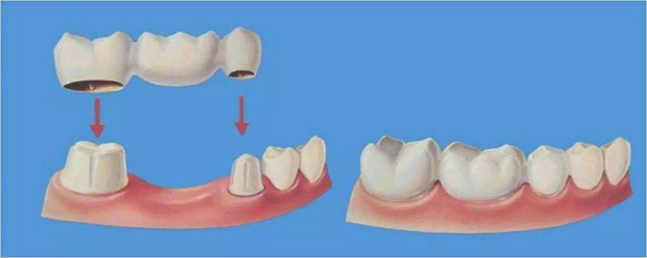 牙齿缺失怎么办杭州应该去哪里修复牙齿选择种植牙固定桥还是活动假牙