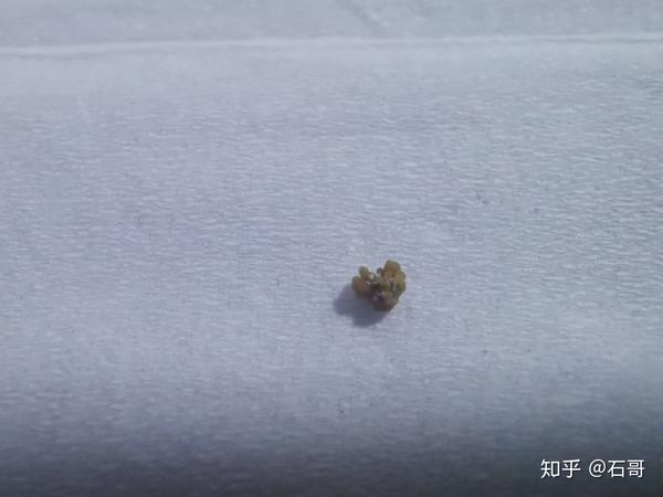 怎样让肾结石快速排出?各类尺寸的结石这样排才有用