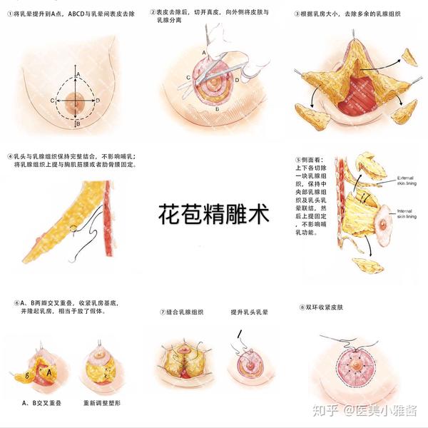 乳房下垂:双环?倒t?花苞?不同矫正术如何选择?