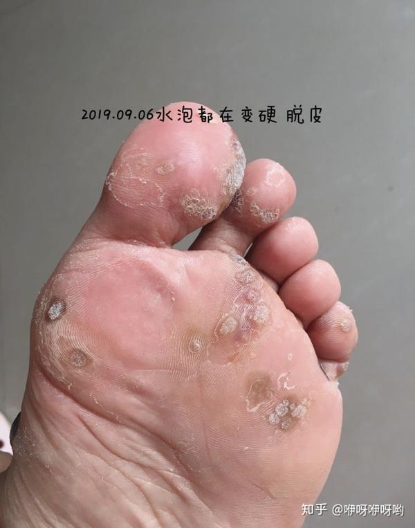 (多图慎入)终于鼓足勇气去治疗寻常疣!那是怎一个痛字
