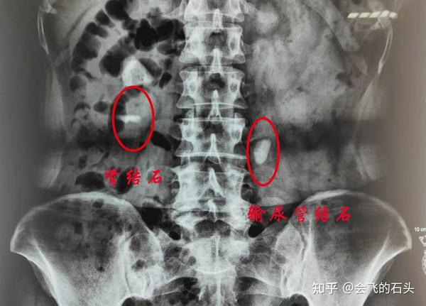 图| 肾,输尿管结石x光片