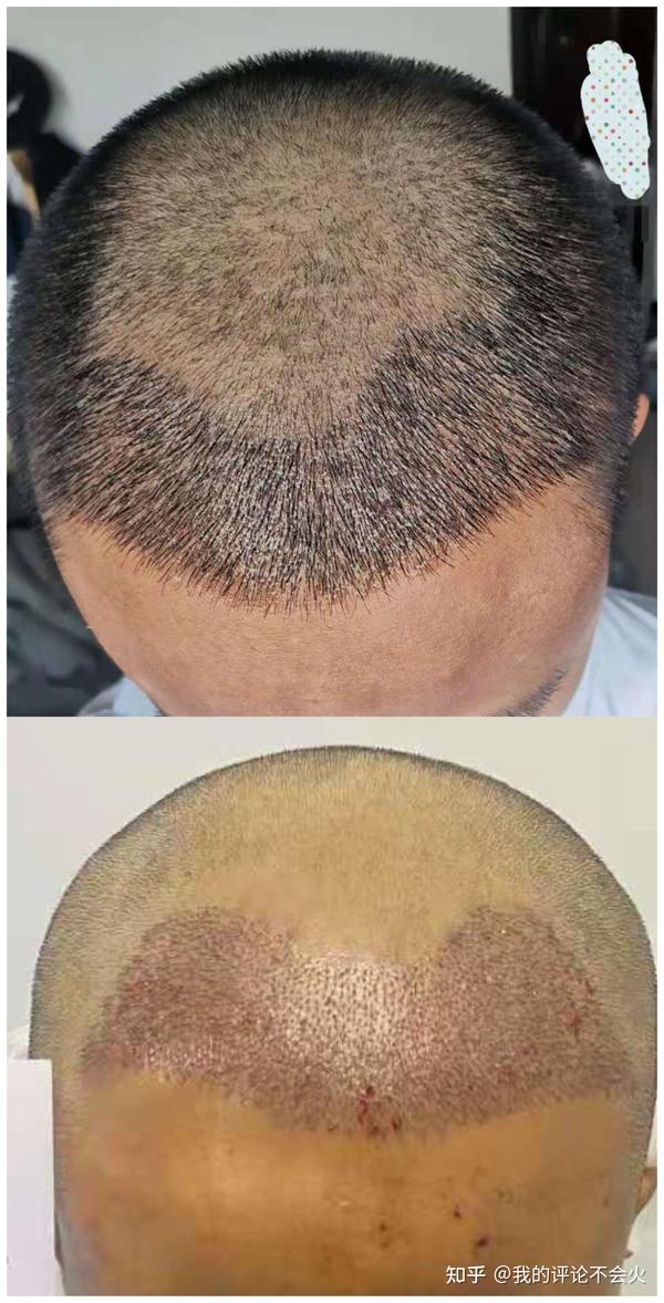 25岁秃头少年的自我救赎植发及恢复实录二植发第二周记录