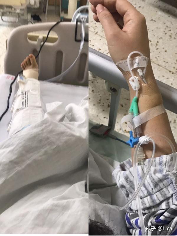 半月板撕裂做关节镜手术是一个什么体验~(下)