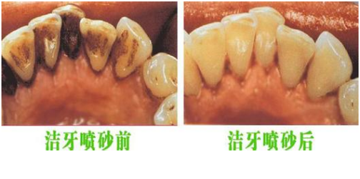 牙周病的非手术治疗技术.