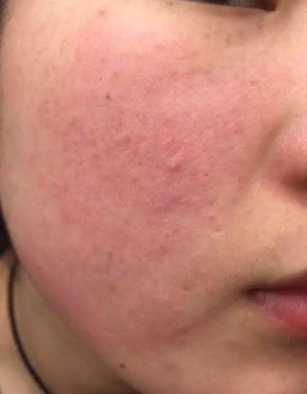修复红血丝哪个牌子的化妆品效果明显?