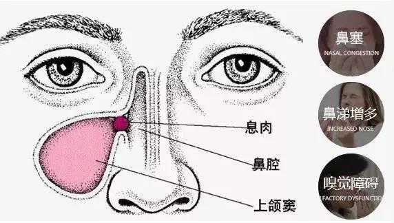 鼻息肉是我们生活中常见的鼻部疾病,它是由于鼻腔和鼻窦黏膜极度水肿