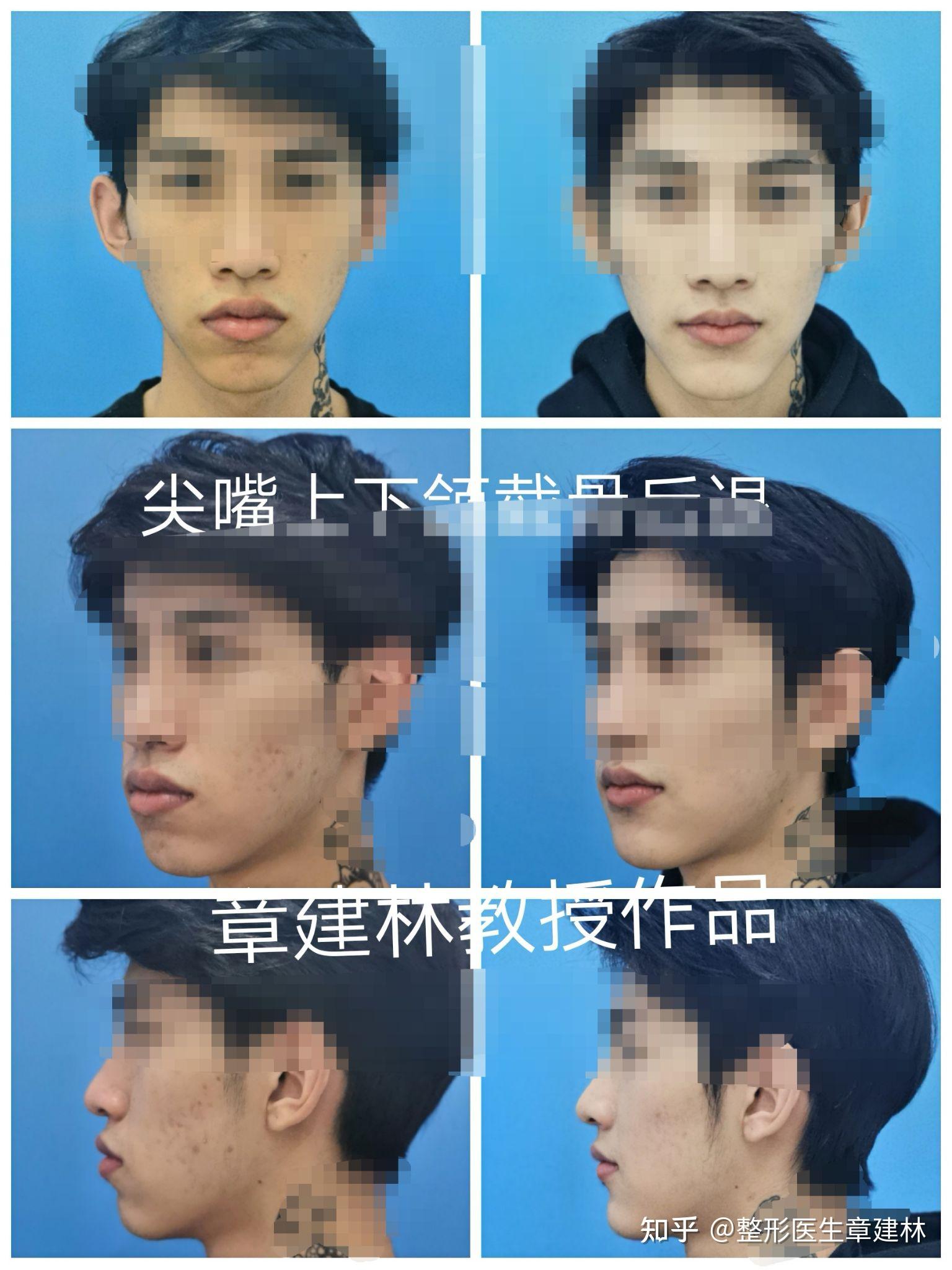 请问我的凸嘴如何改善